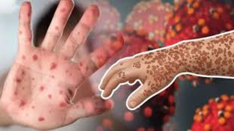 দেশে ২৪ ঘণ্টায় ১,১৫১ সন্দেহজনক হাম রোগী, নতুন মৃত্যু নেই